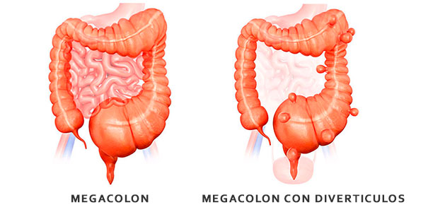 anatomía anómala del colon